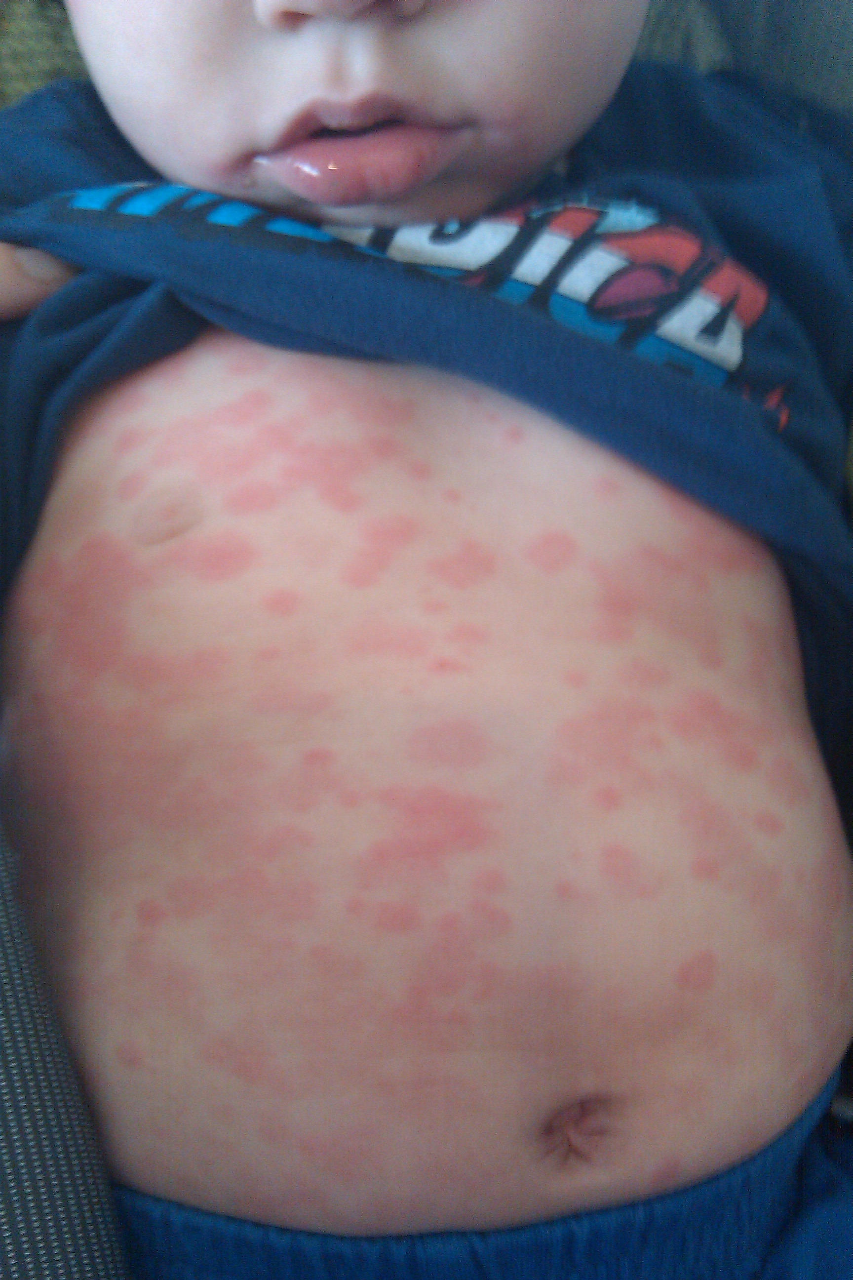 pictures of strep rash | Lifescript.com